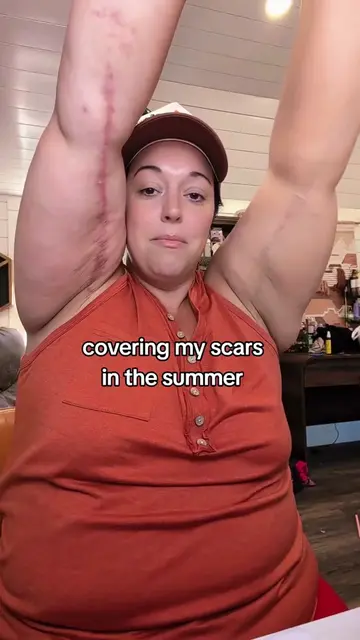 brachioplasty scar coverup #dealsforyoudays #westmorebeauty